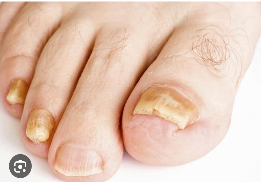 ONICOMICOSIS ( HONGOS EN LA UÃ‘A)
