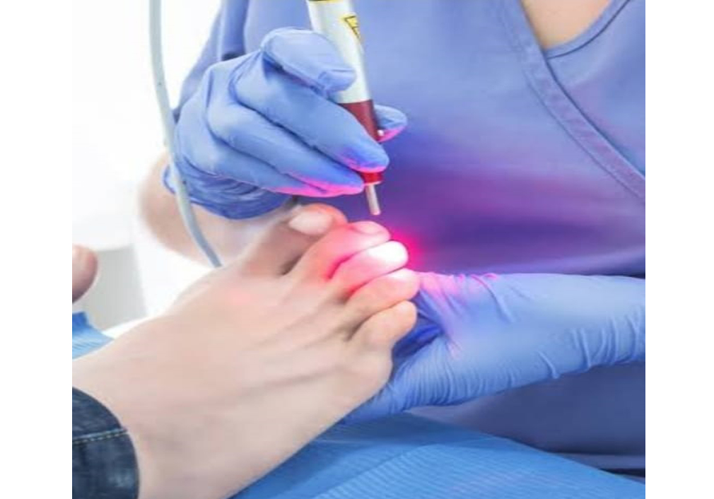 TRATAMIENTO LASER PARA HONGOS